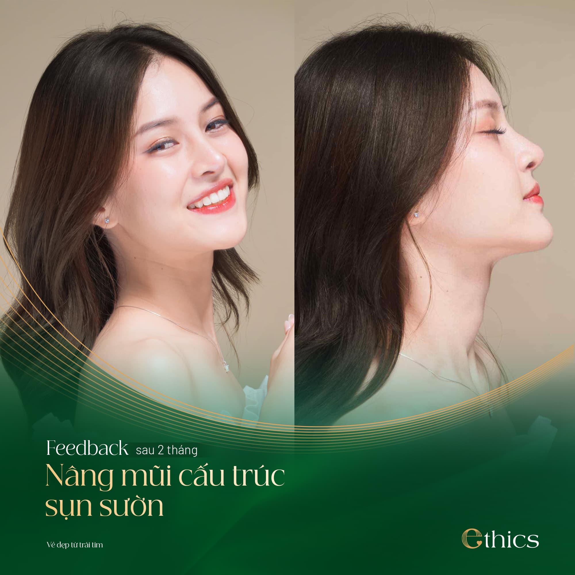 Nâng mũi cấu trúc