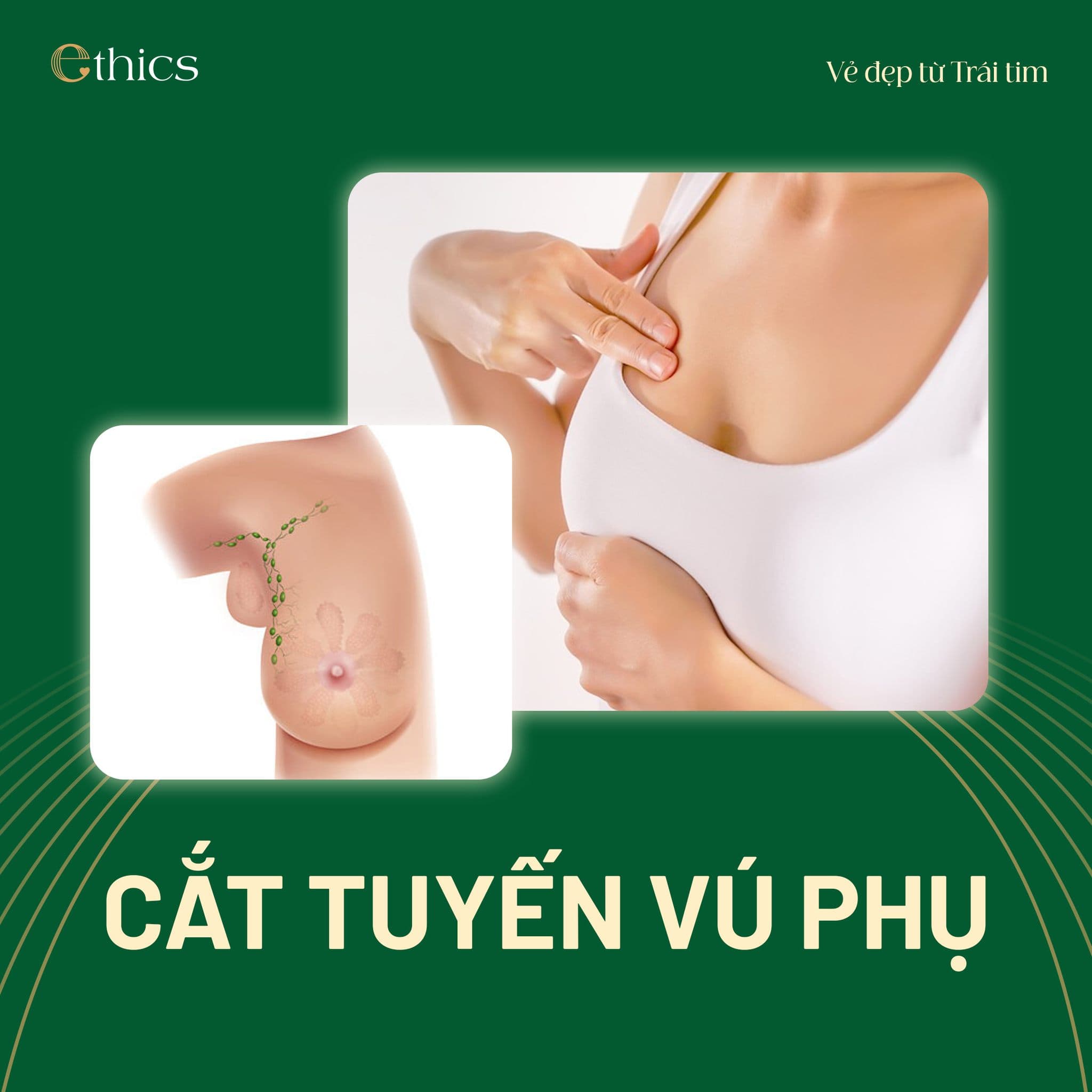 Cắt tuyến vú phụ