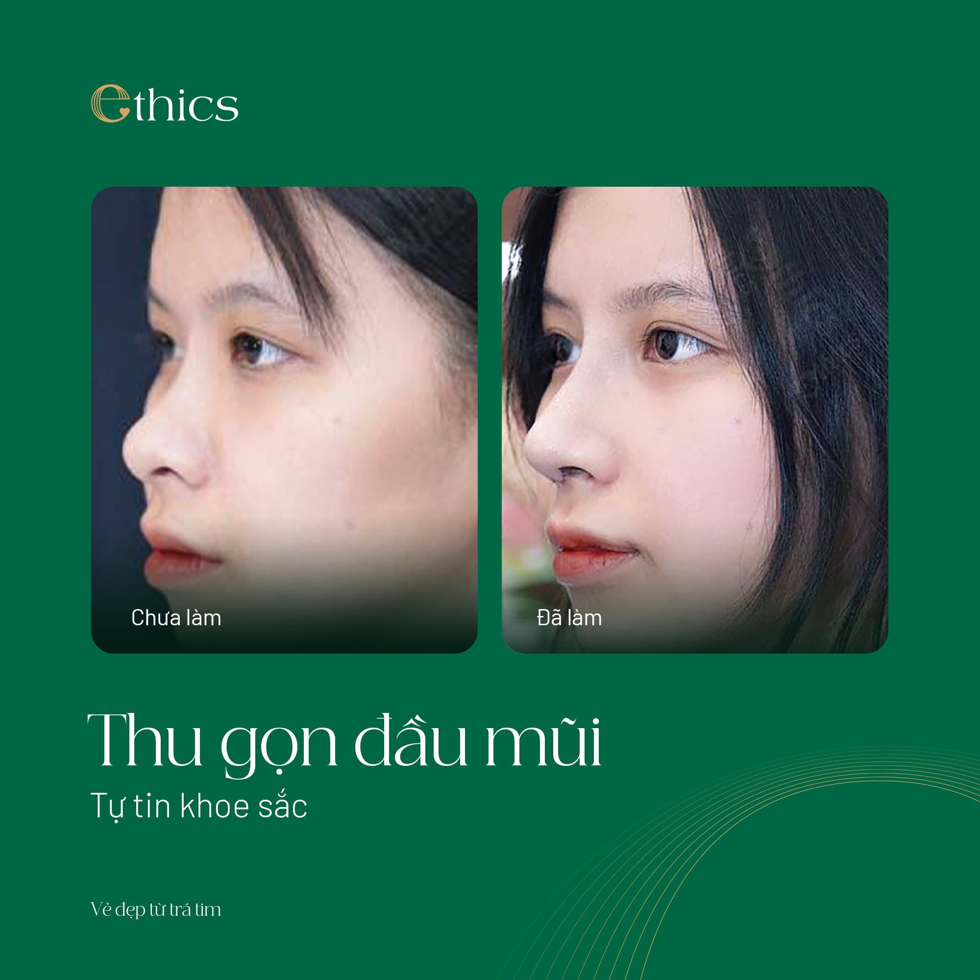 Thu gọn đầu mũi