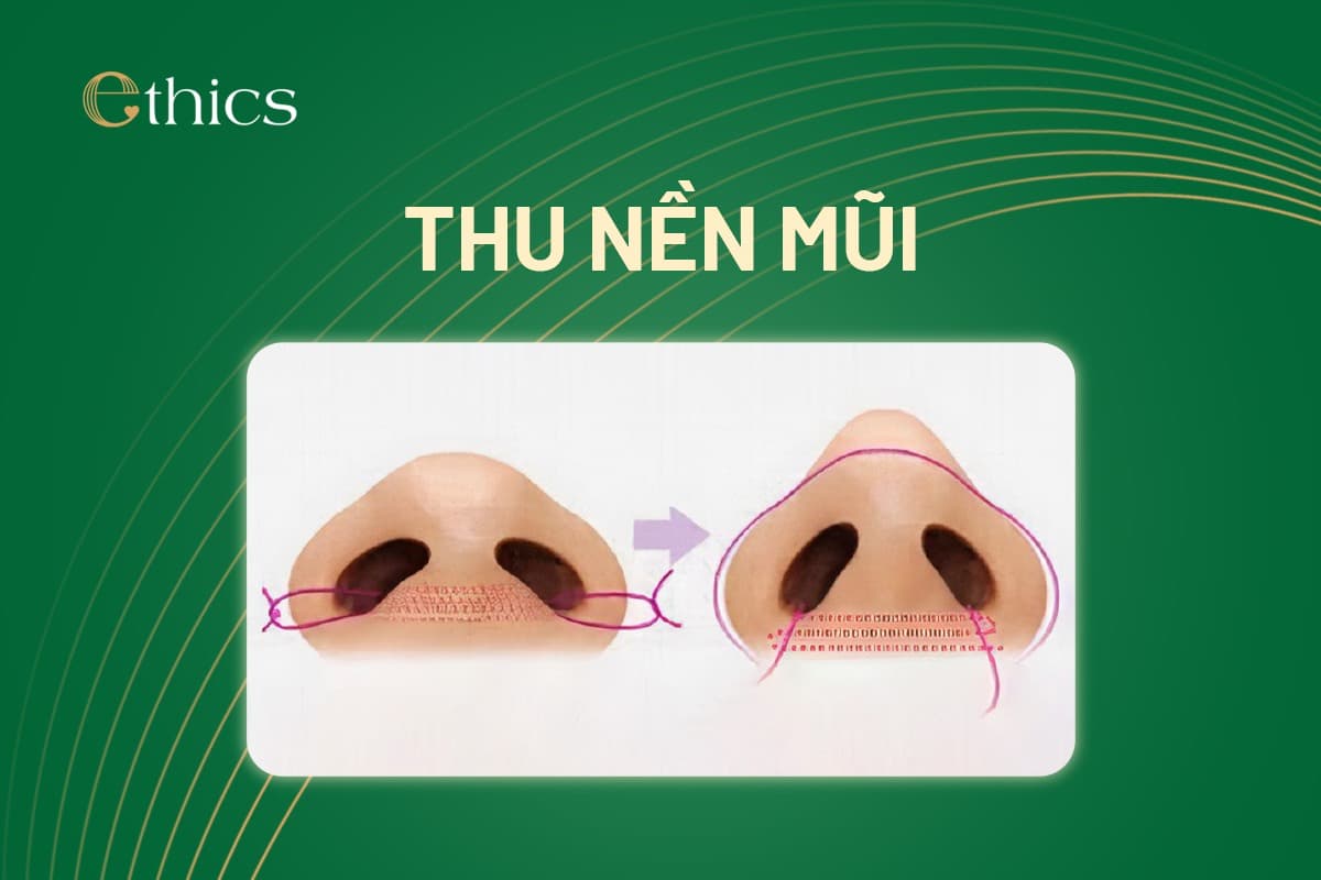 Thu nền mũi