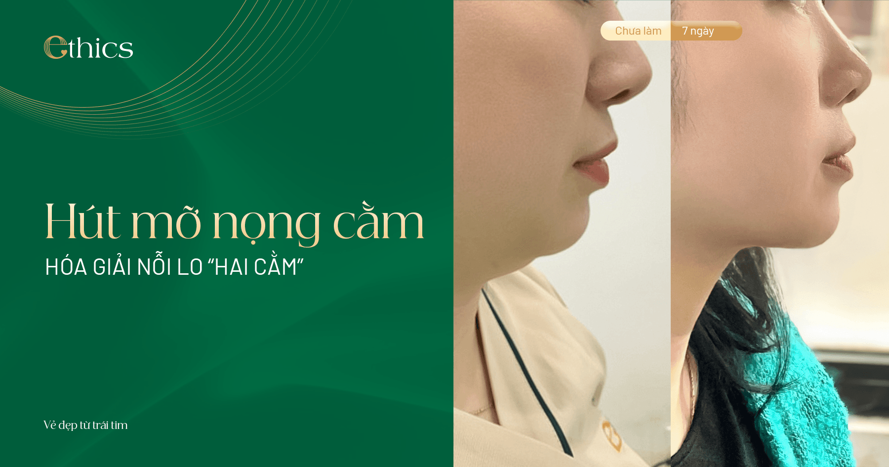 Hút mỡ nọng cằm