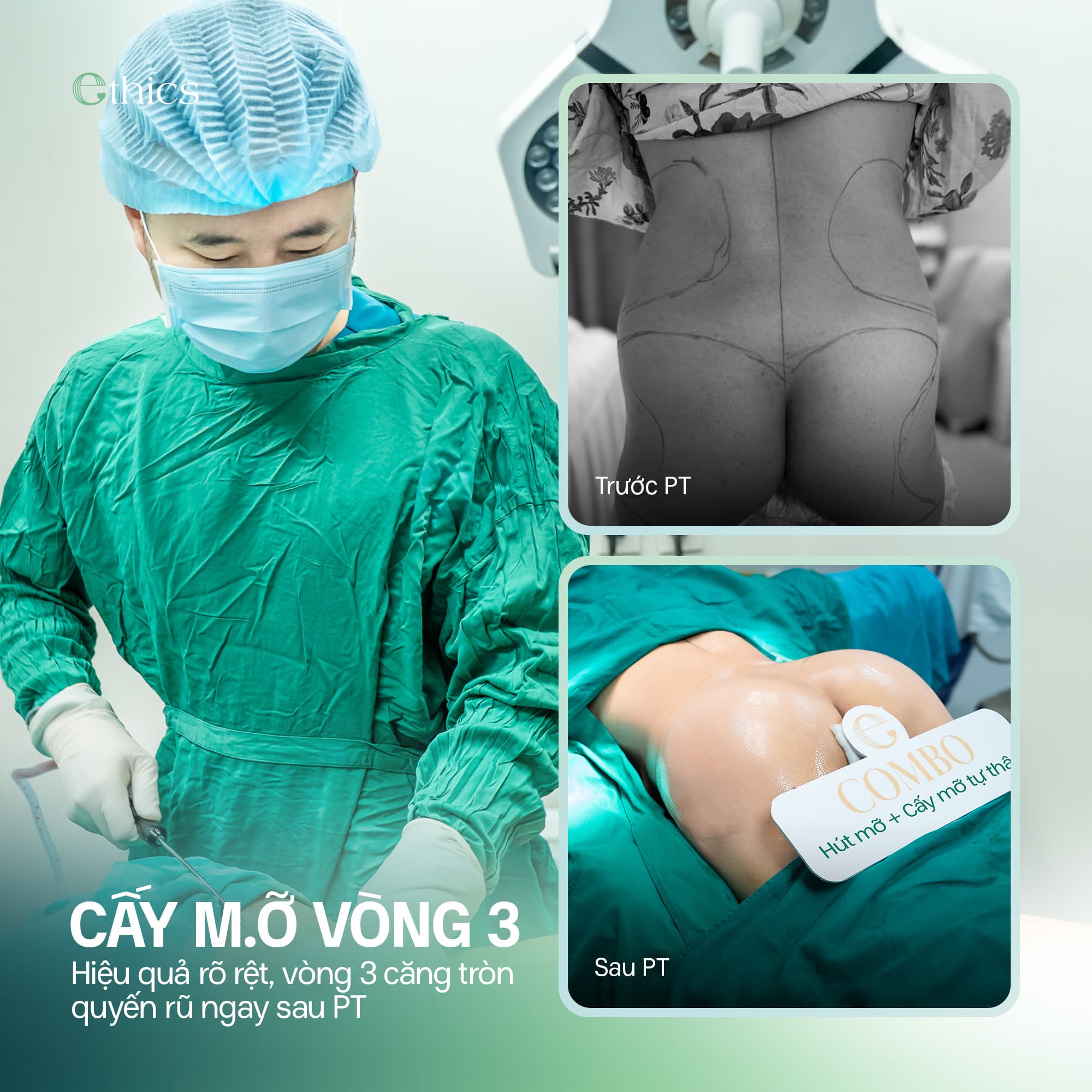 Cấy mỡ mông toàn thể
