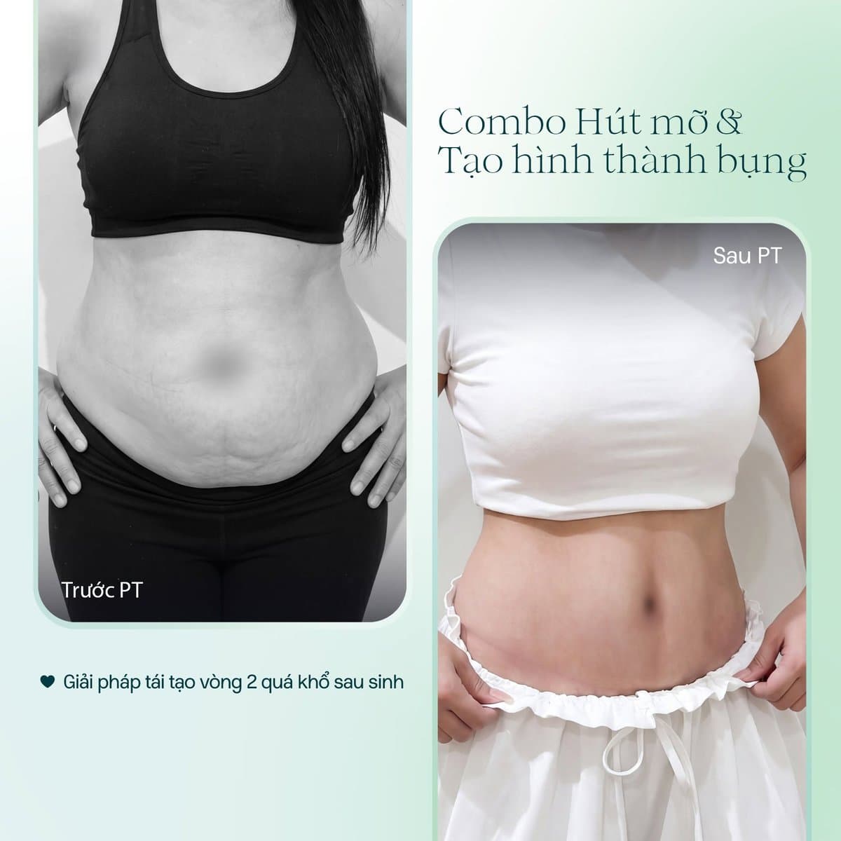 HÚT MỠ TẠO HÌNH