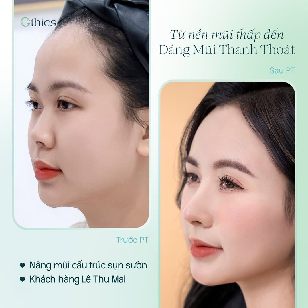 Ảnh ca nâng mũi cấu trúc sụn sườn Lê Thu Mai do Ethics đăng ngày 20/09/2026