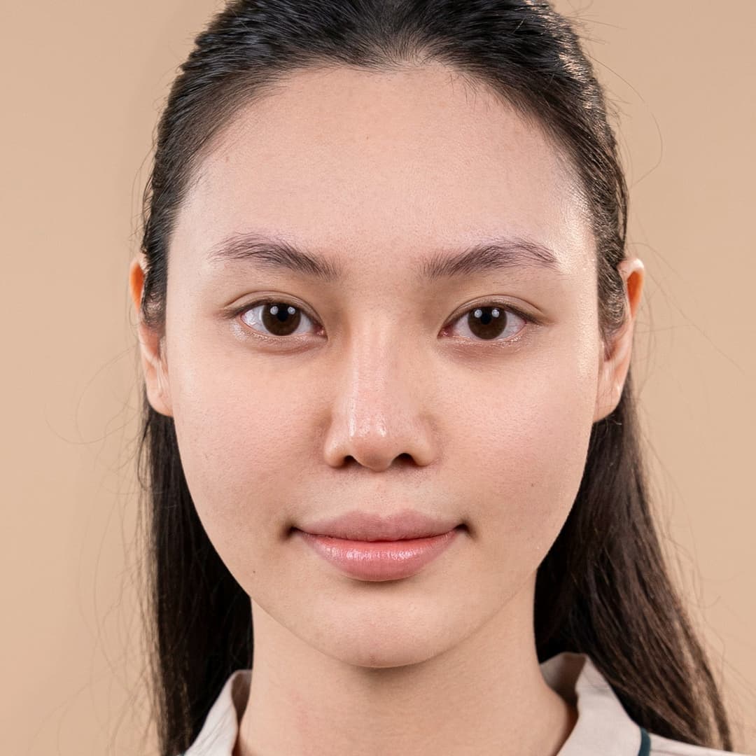 Khách hàng Lưu Phương Anh - Trước can thiệp nâng mũi One fit