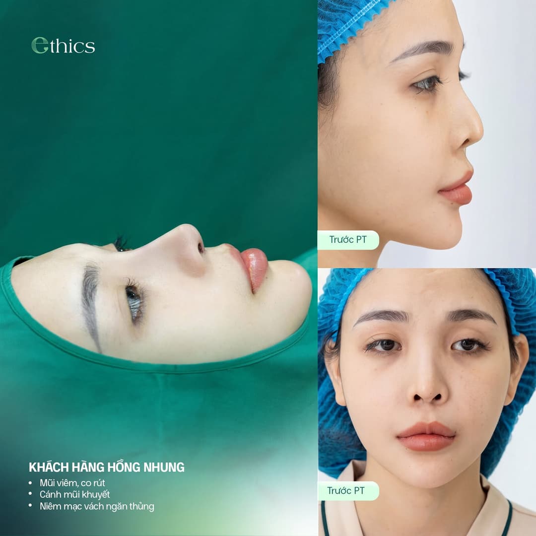 Ảnh bài đăng Ethics về ca nâng mũi cấu trúc sụn sườn