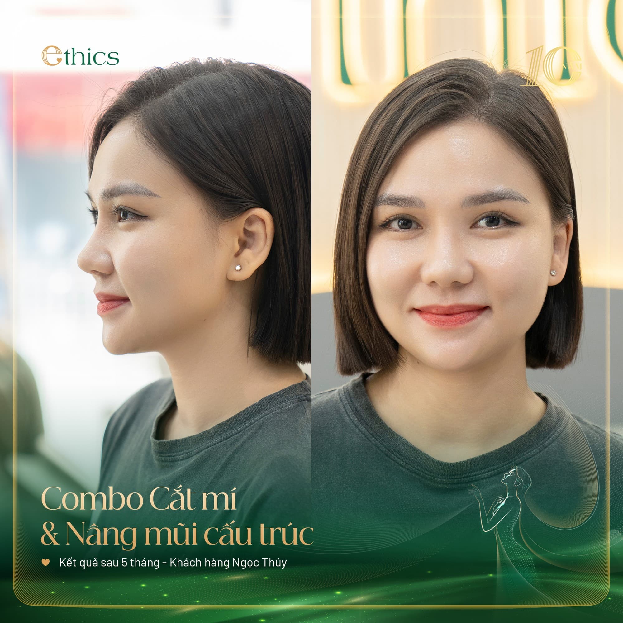Thu gọn quầng vú