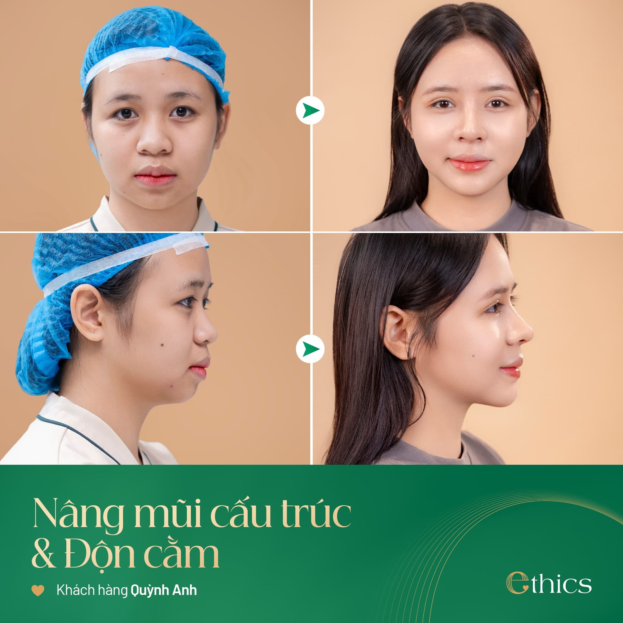 Độn cằm Ethics (Softxil)
