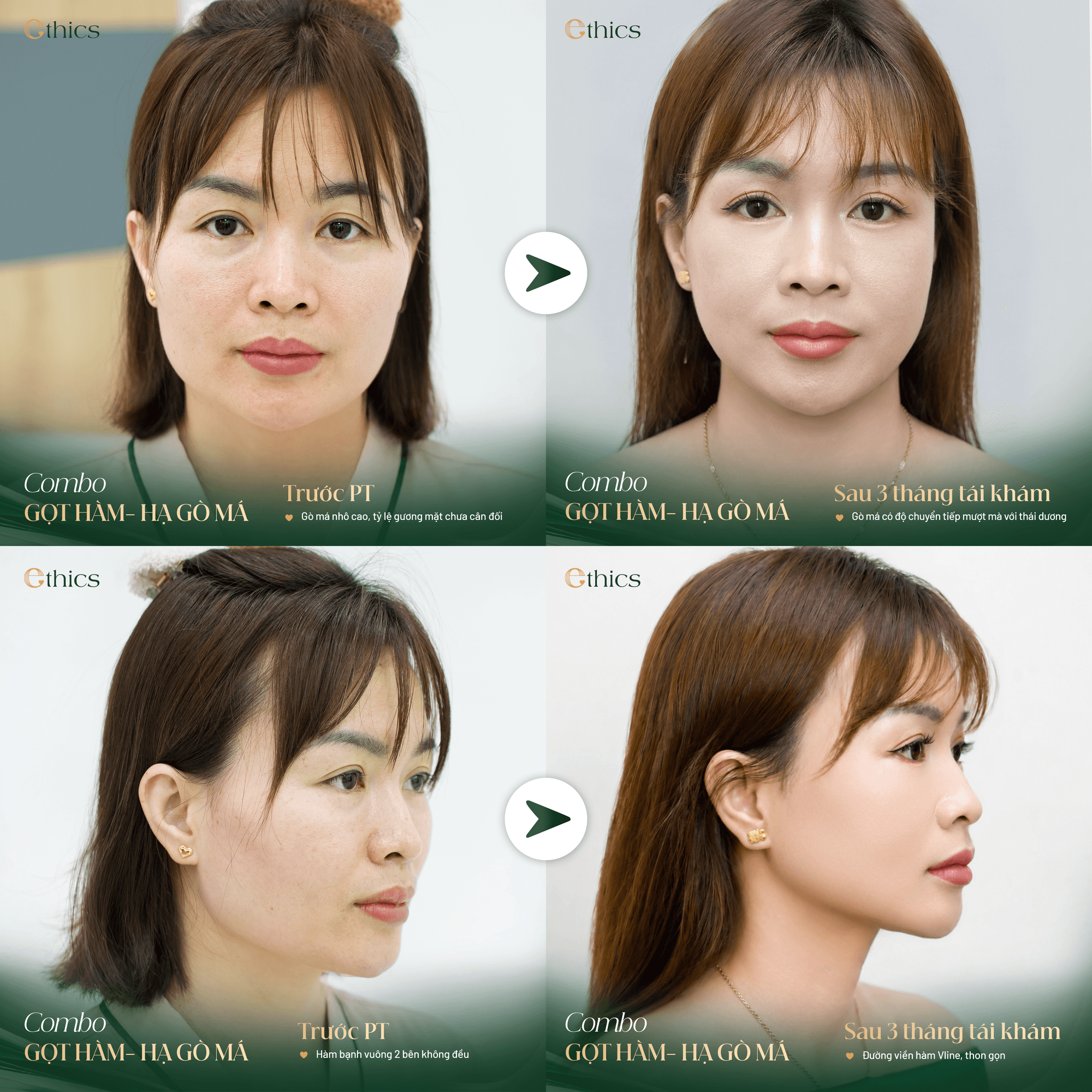 Phẫu thuật hàm móm 1 hàm