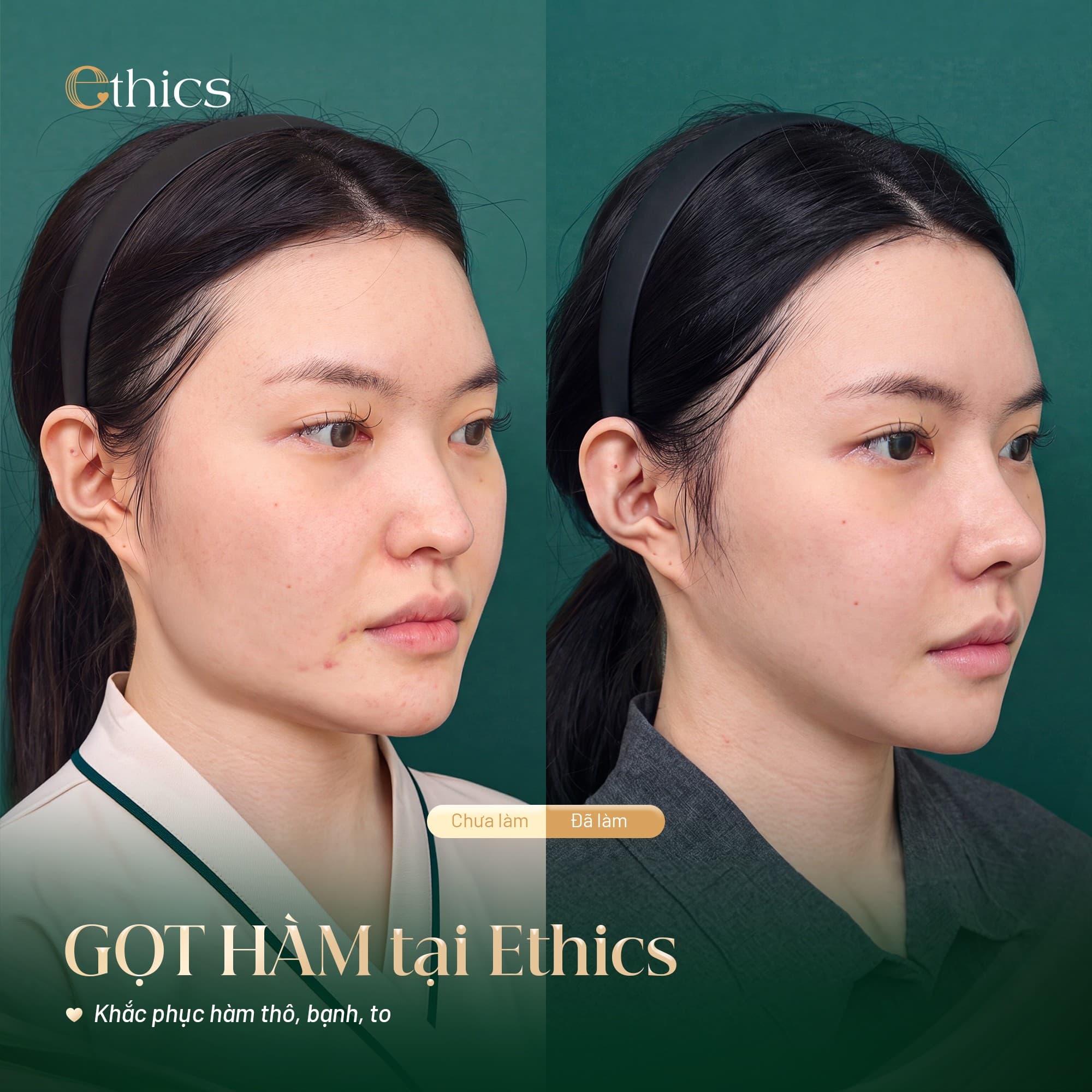 Tháo nẹp vít – áp dụng cho 2 dịch vụ
