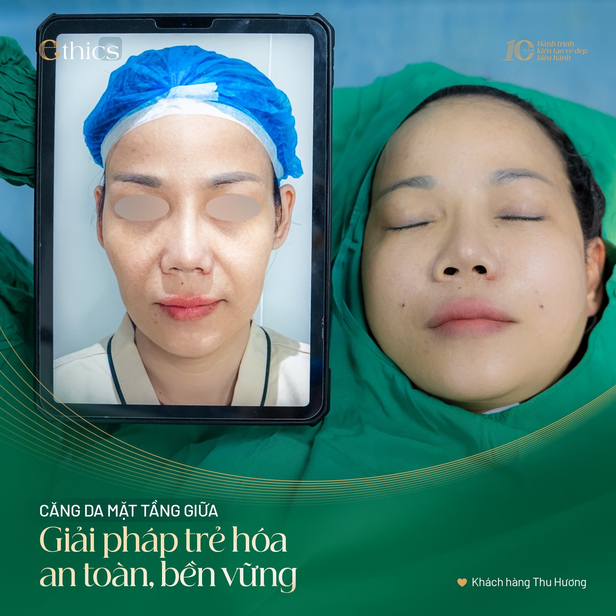 Cắt xương góc hàm + căng da + hạ gò má