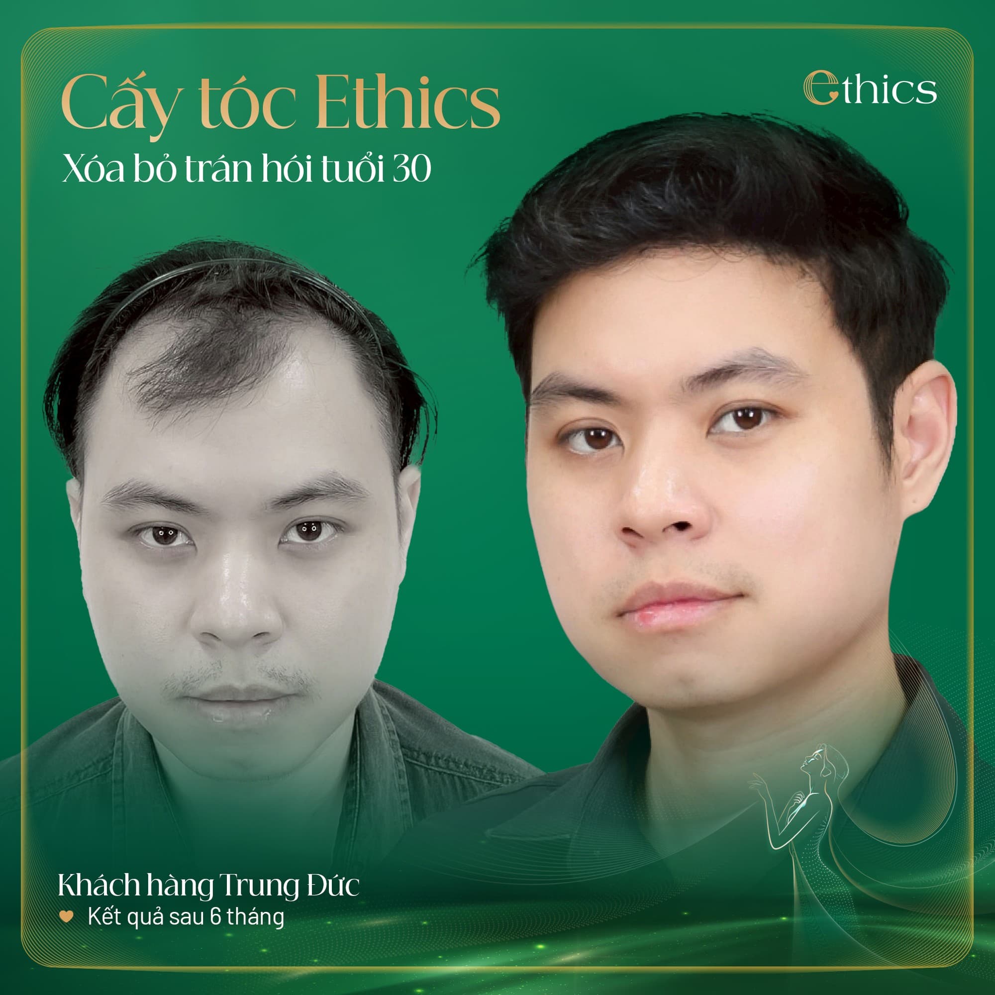 Cấy mỡ bàn tay