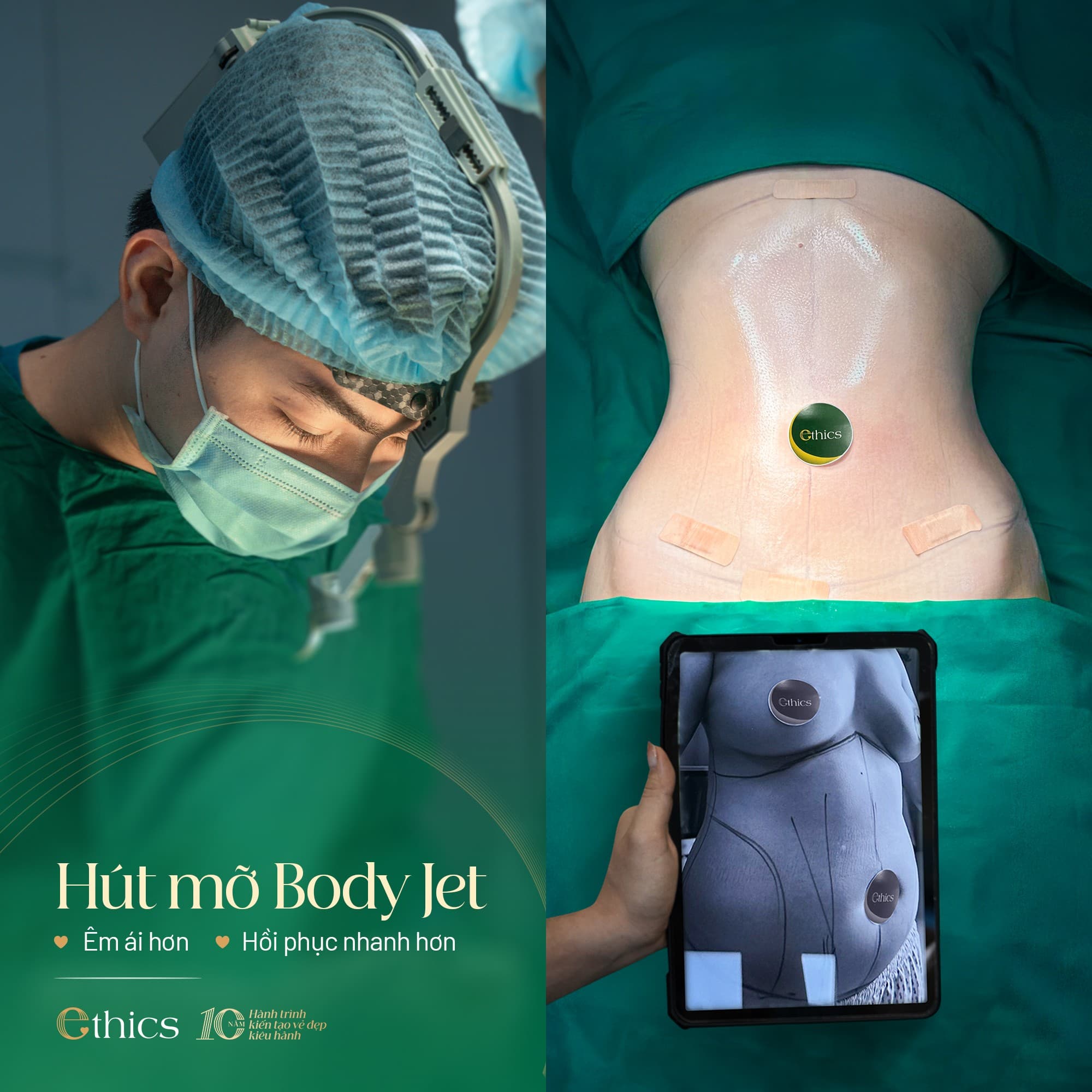 Hút mỡ Body Jet