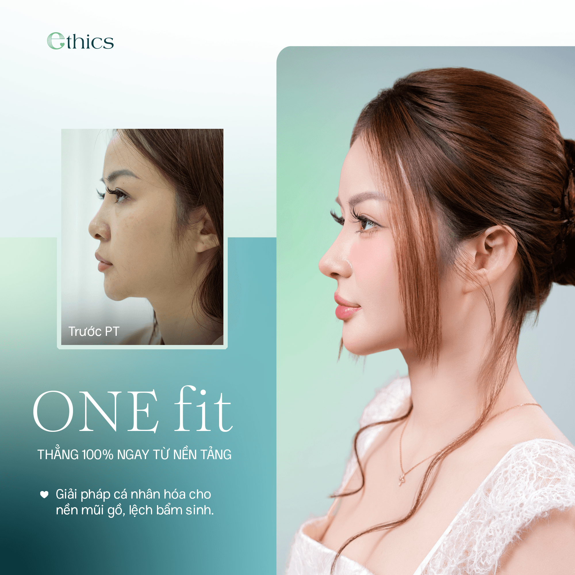 Nâng mũi OneFit Premium