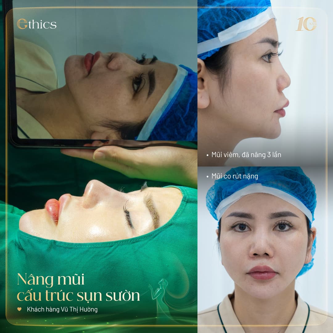 Ghép sụn tự thân chỉnh hình mũi Ethics