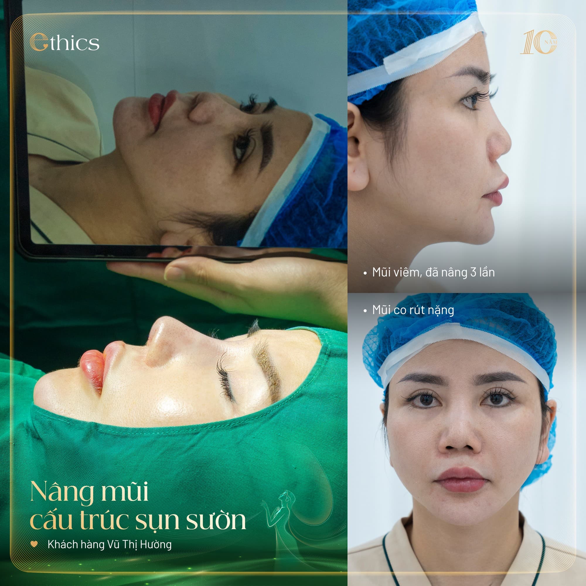 Ghép sụn
