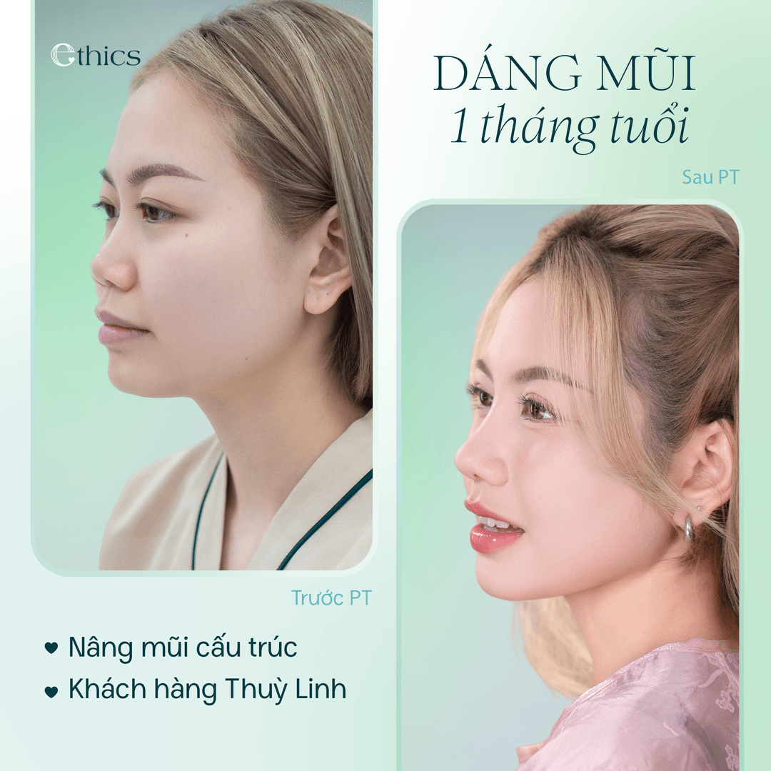 Hình ảnh so sánh trước và sau khi nâng mũi cấu trúc của khách hàng