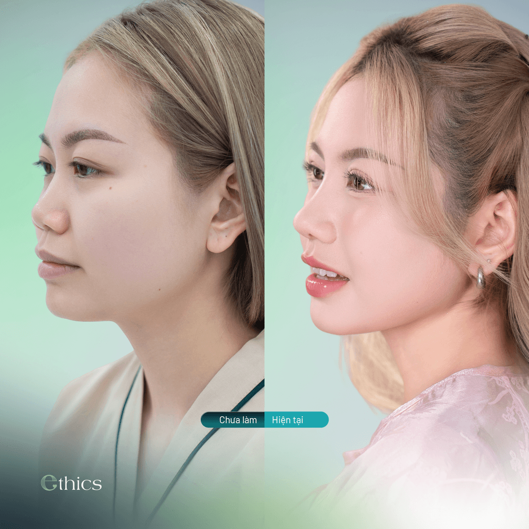 NÂNG MŨI LÀ QUYẾT ĐỊNH ĐÚNG ĐẮN NHẤT TRONG HÀNH TRÌNH THAY ĐỔI NHAN SẮC CỦA MÌNH