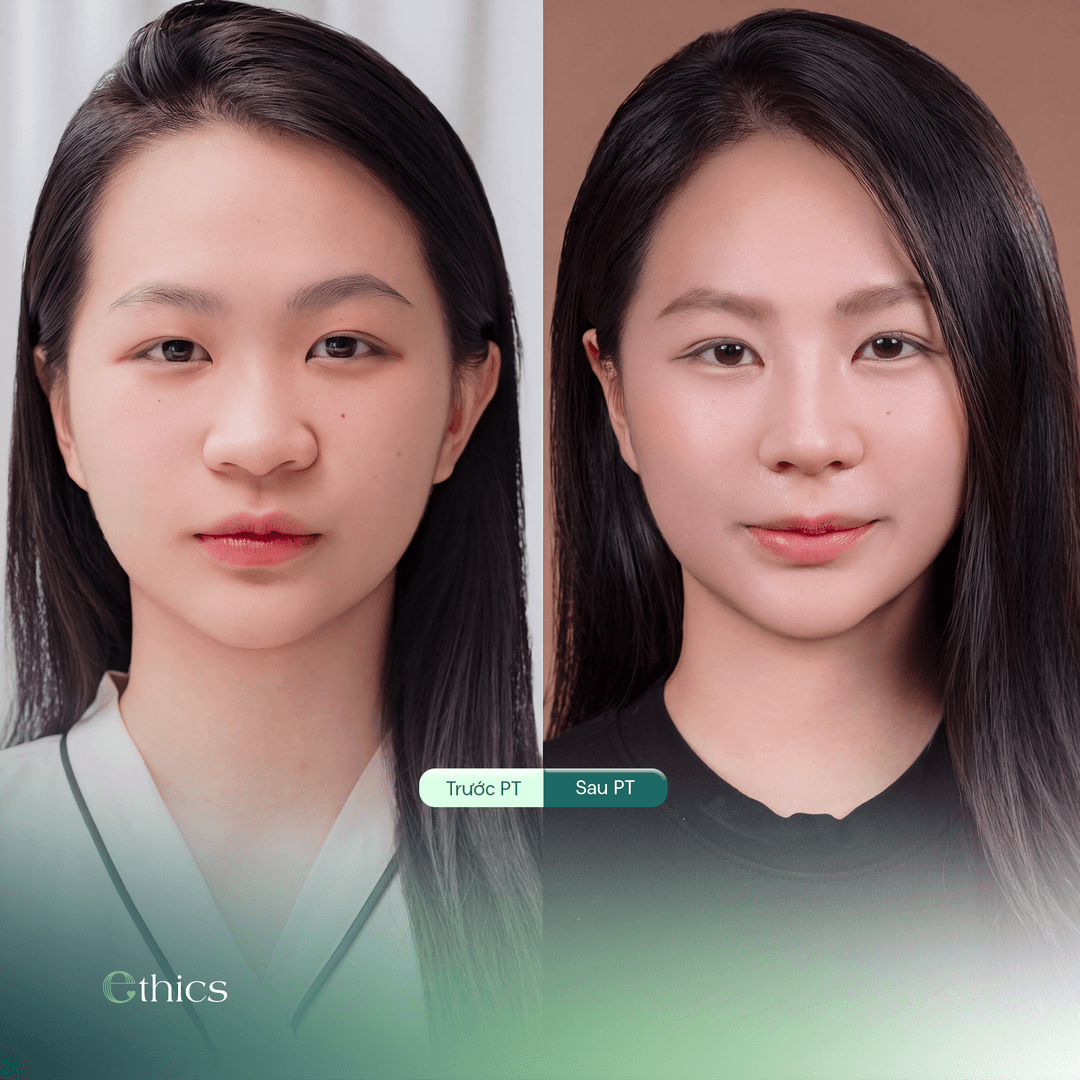 SỰ HÀI LÒNG NGÀY TÁI KHÁM - KHÁCH HÀNG KIM NƯƠNG