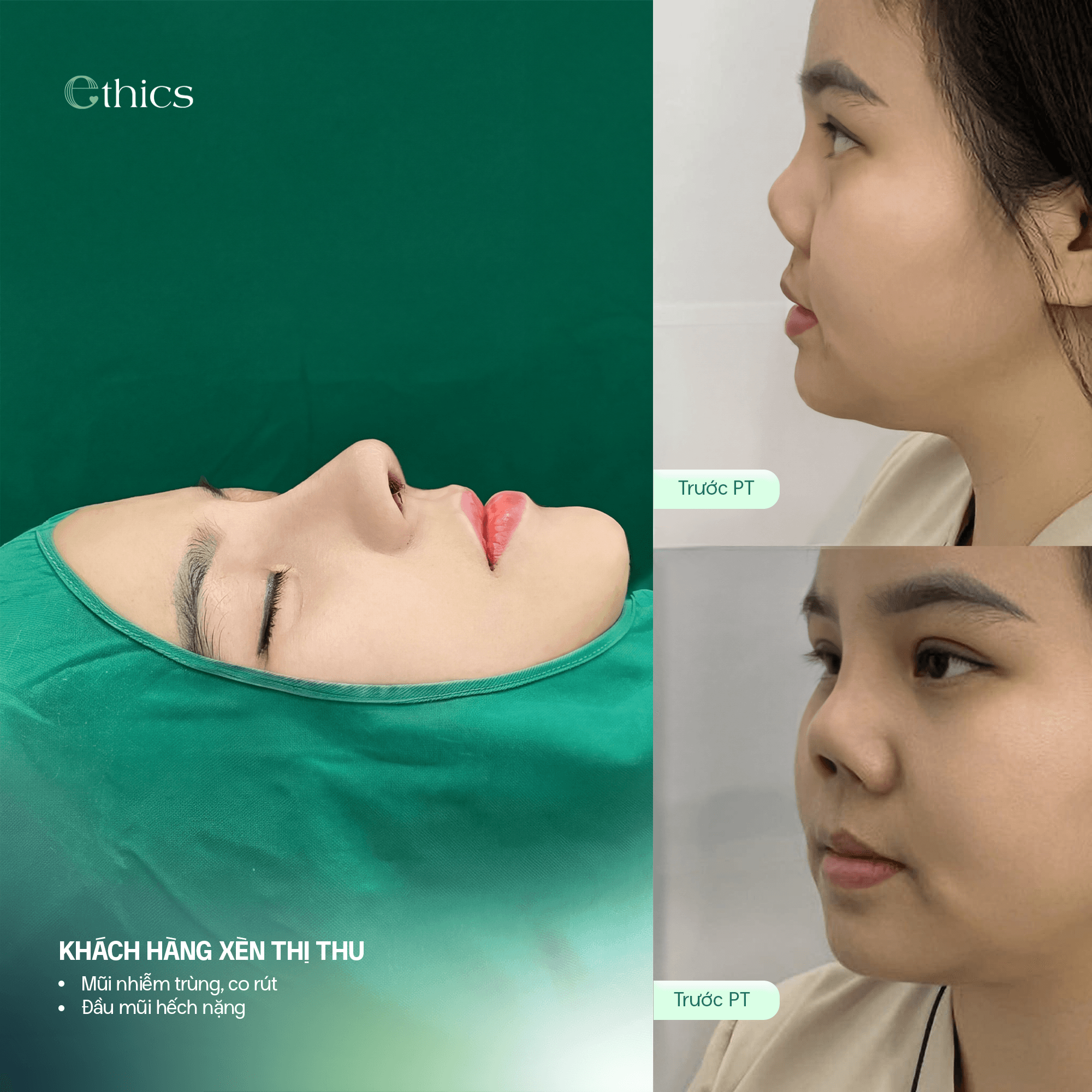 Hình ảnh so sánh trước khi nâng mũi cấu trúc của khách hàng