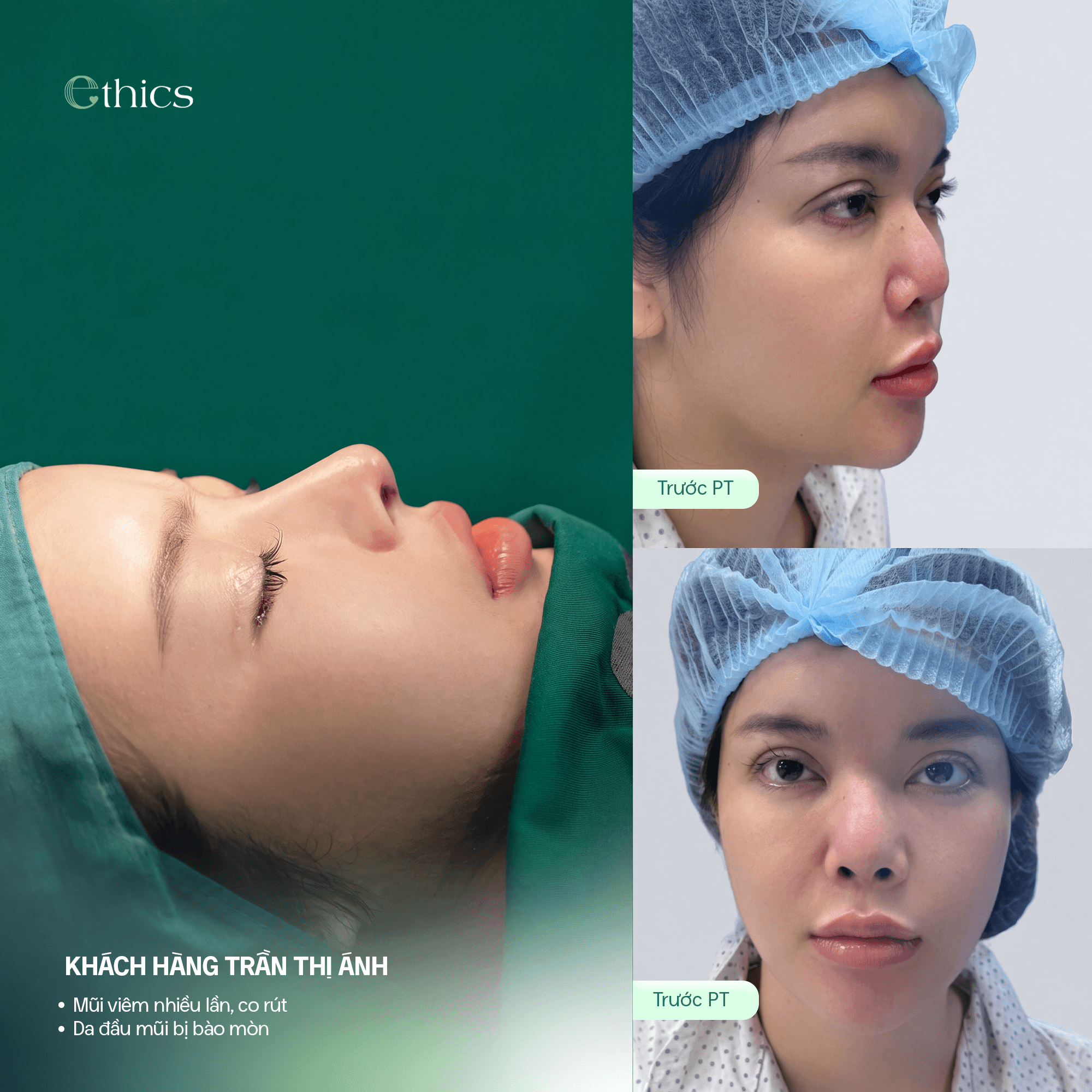 Hình ảnh khách hàng trước phẫu thuật nâng mũi cấu trúc sụn sườn