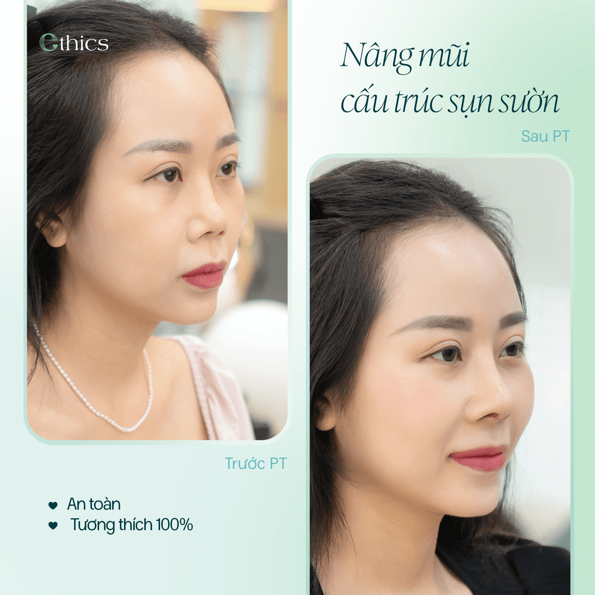 NÂNG MŨI CẤU TRÚC SỤN SƯỜN - ĐẸP TINH TẾ, BỀN VỮNG THEO THỜI GIAN