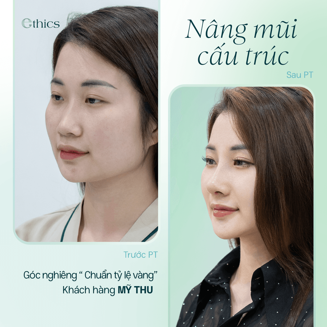 NÂNG MŨI CẤU TRÚC - 10 NGÀY CHO MỘT DIỆN MẠO MỚI