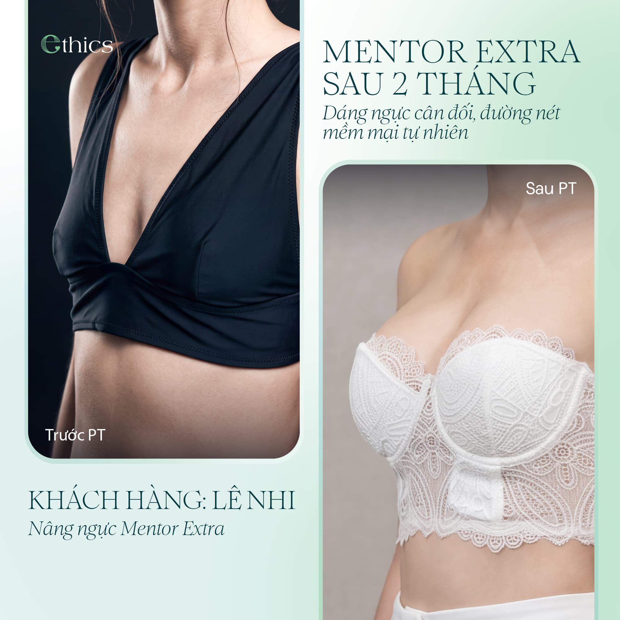 MENTOR EXTRA SAU 2 THÁNG - DÁNG NGỰC CÂN ĐỐI, ĐƯỜNG NÉT MỀM MẠI TỰ NHIÊN