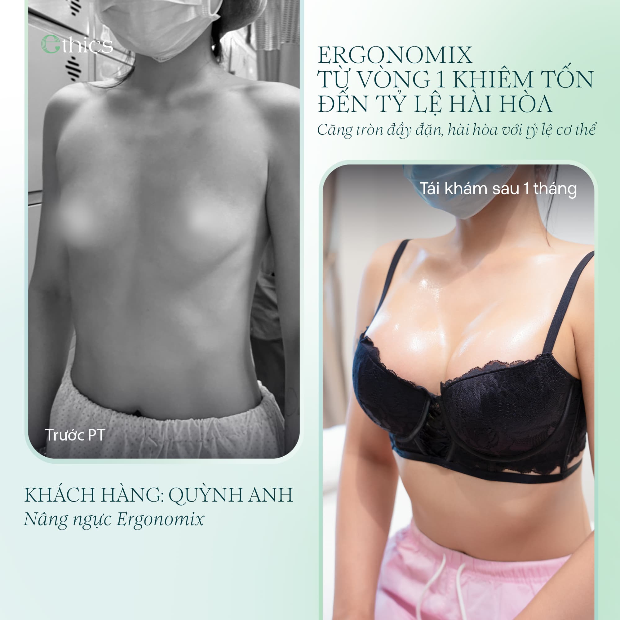 MỘT THÁNG SAU NÂNG NGỰC ERGONOMIX - VẺ ĐẸP ĐẾN TỪ SỰ VỪA VẶN