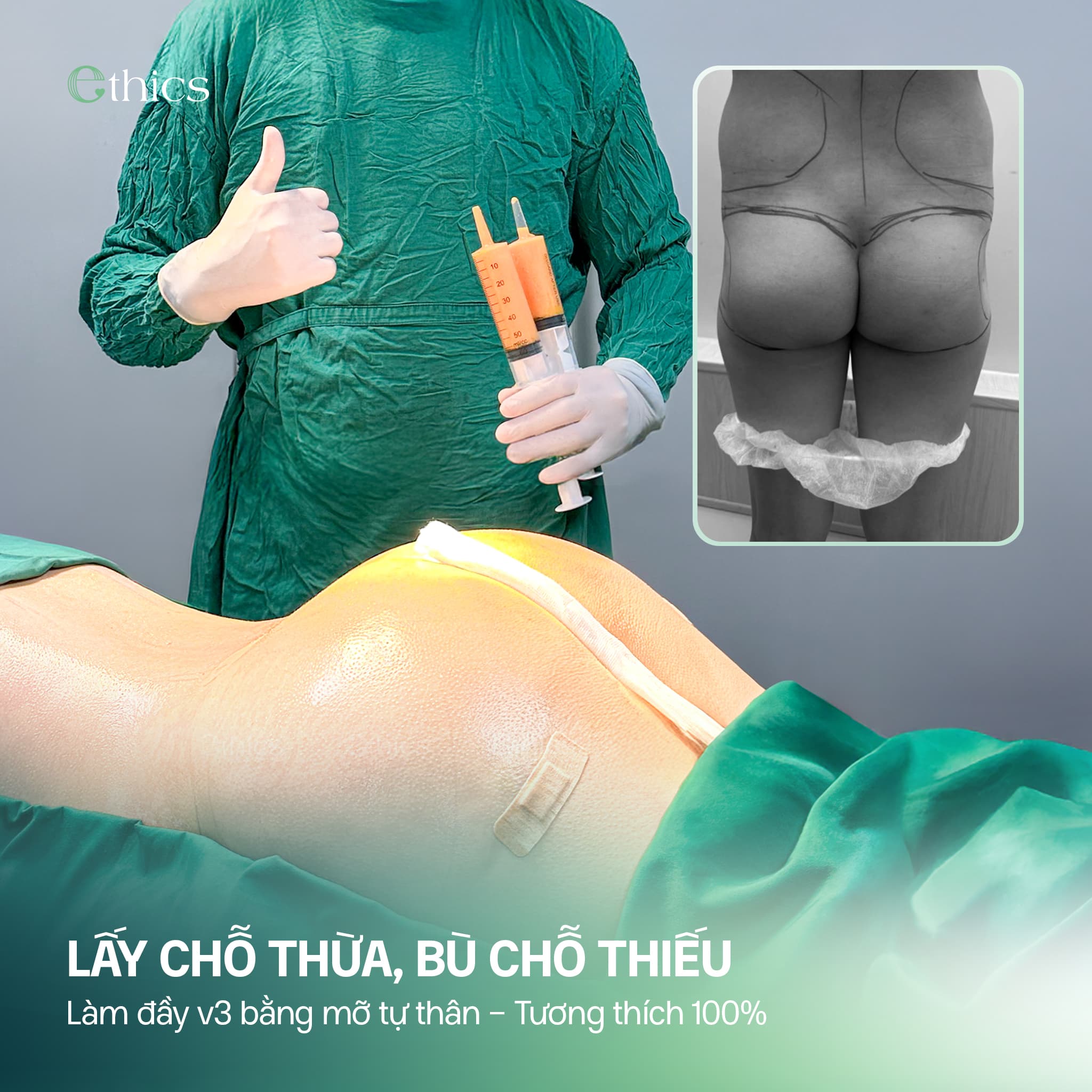 LẤY CHỖ THỪA, BÙ CHỖ THIẾU - HOÀN THIỆN ĐƯỜNG CONG BẰNG MỠ TỰ THÂN