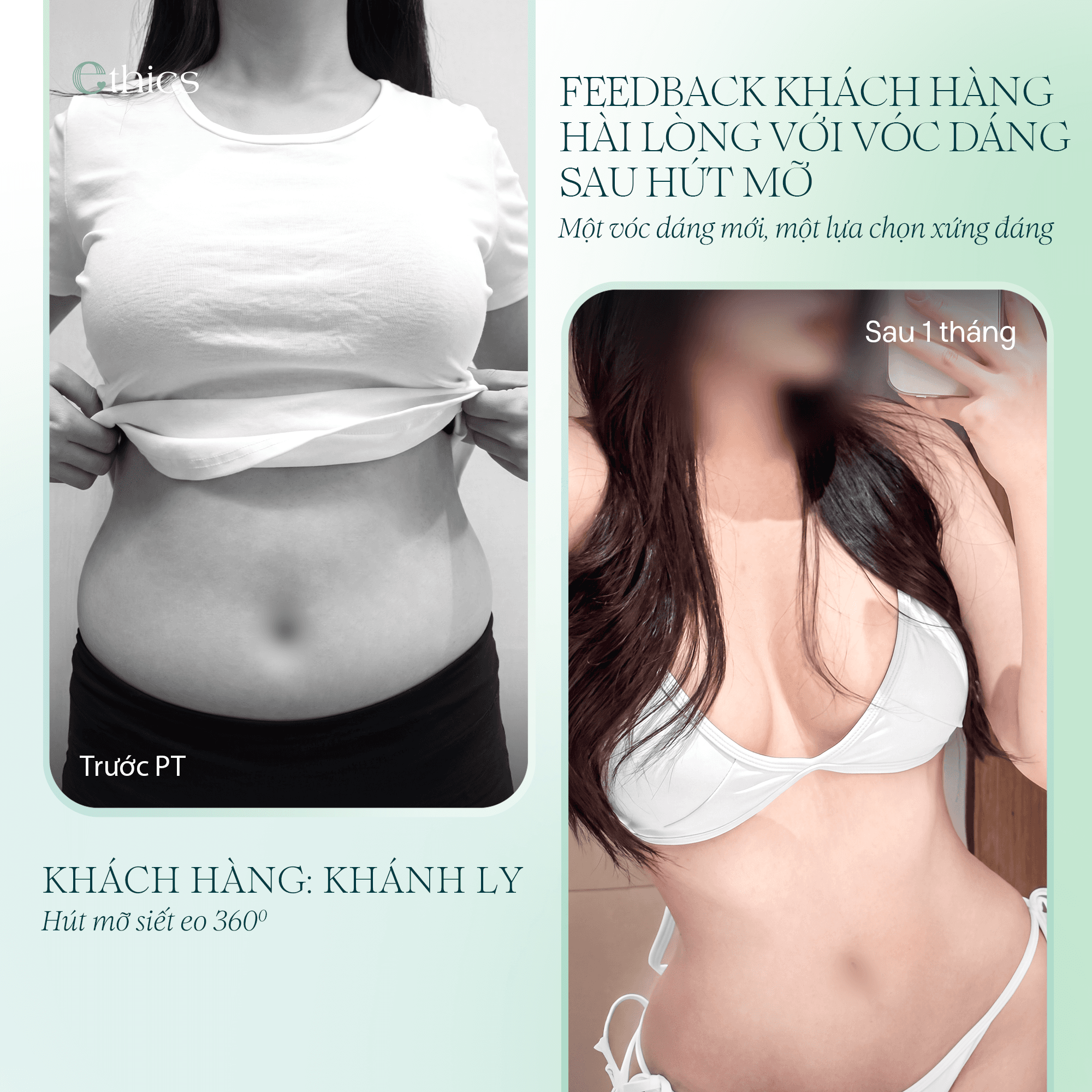 1 THÁNG SAU HÚT MỠ - SỰ HÀI LÒNG HIỆN HỮU TRÊN TỪNG ĐƯỜNG NÉT