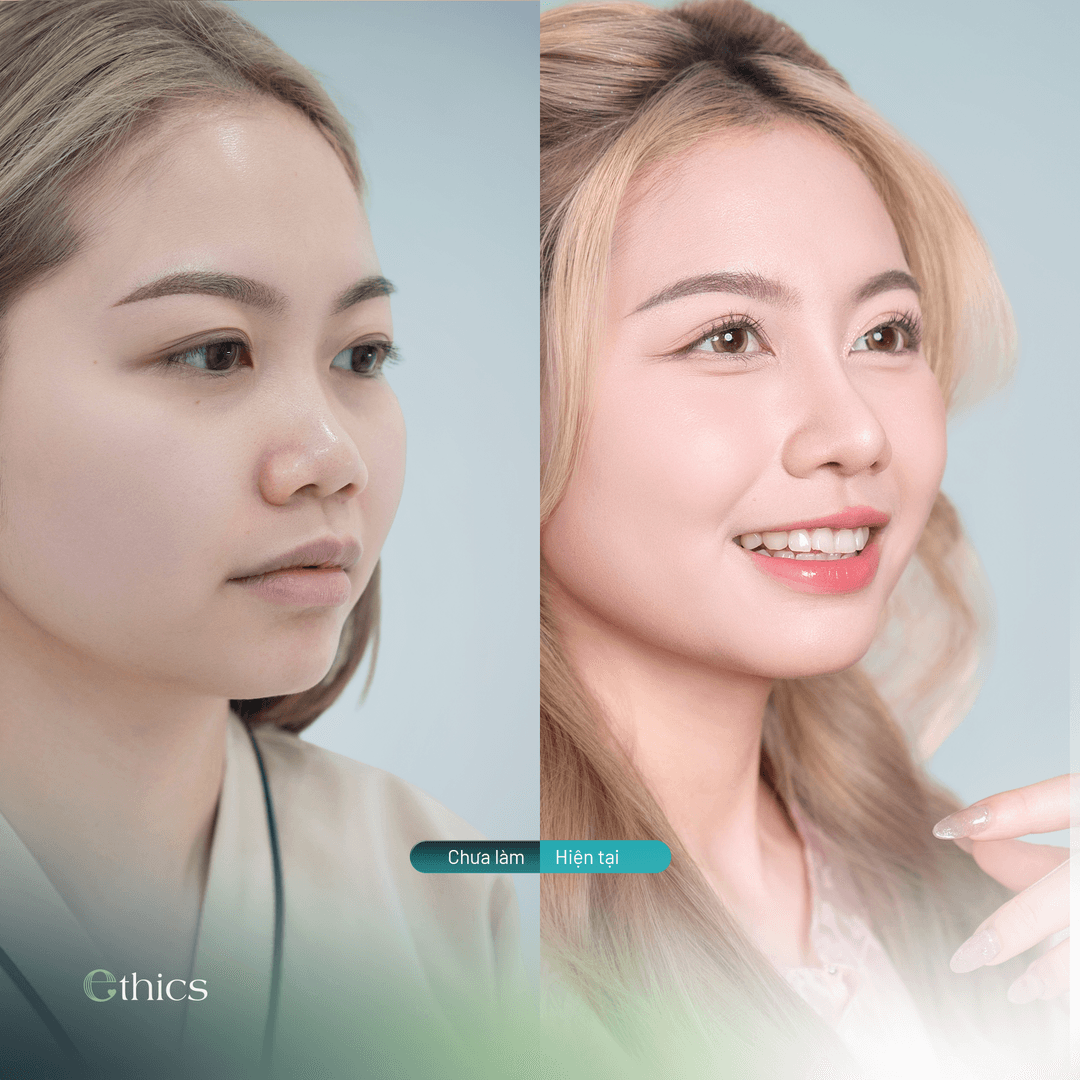 So sánh hình ảnh trước và sau khi nâng mũi của khách hàng