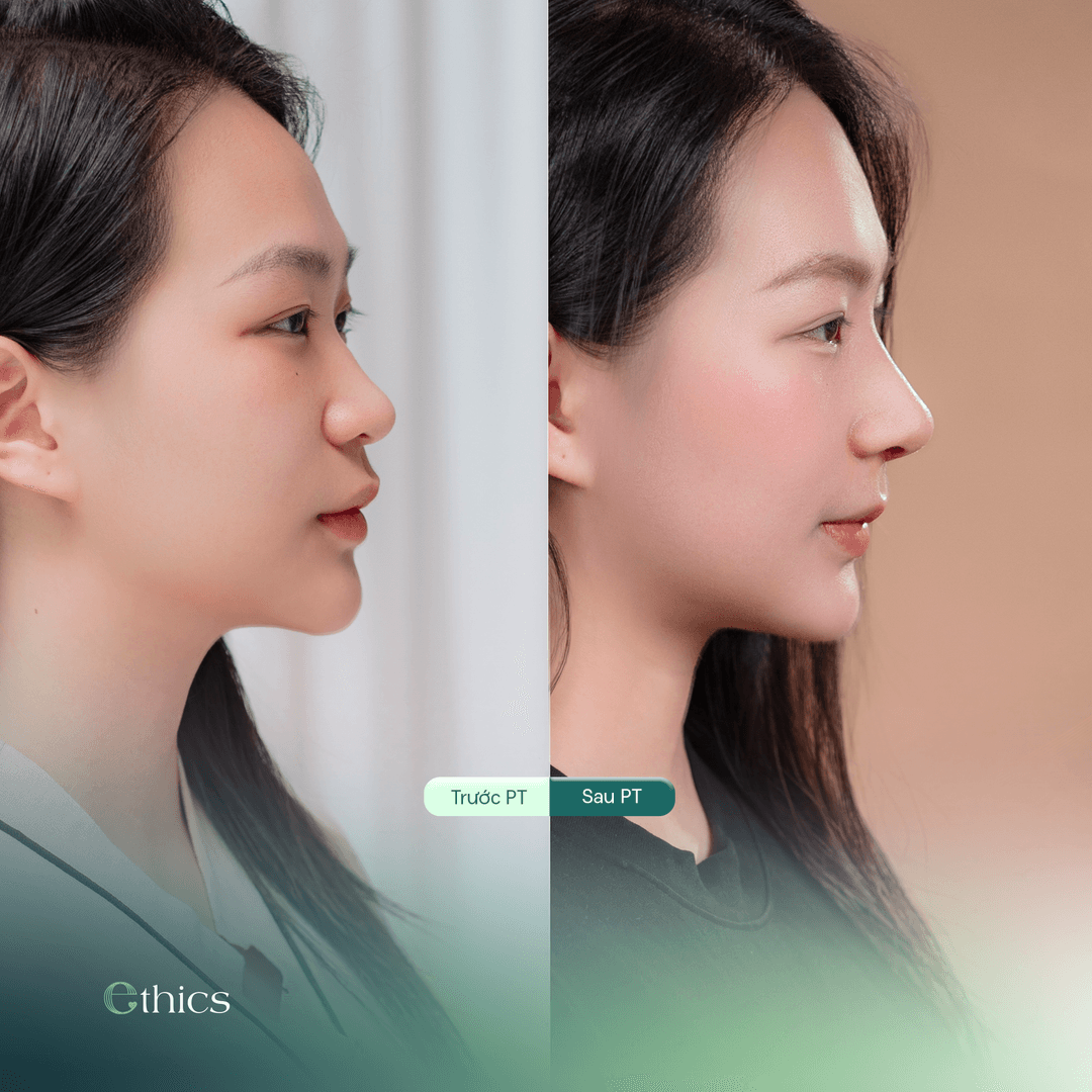 Hình ảnh so sánh trước và sau khi nâng mũi nhìn nghiêng của khách hàng