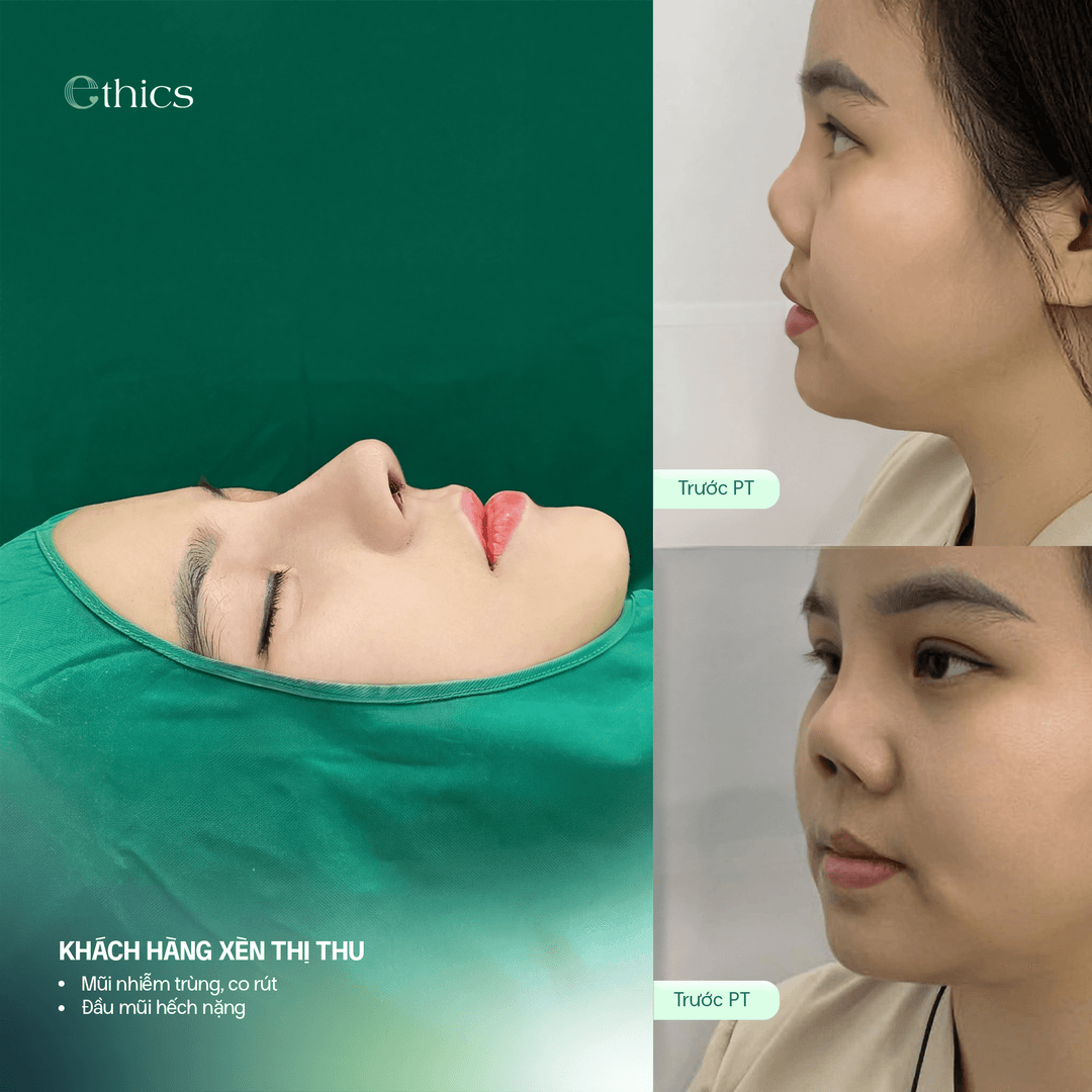 Hình ảnh so sánh trước khi nâng mũi cấu trúc của khách hàng
