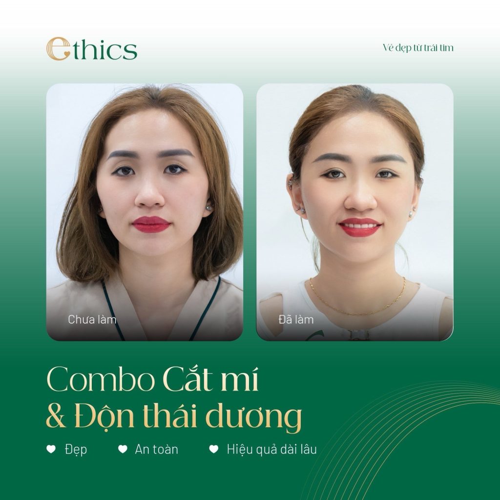 Combo Cắt mí & Độn Thái dương tại Ethics