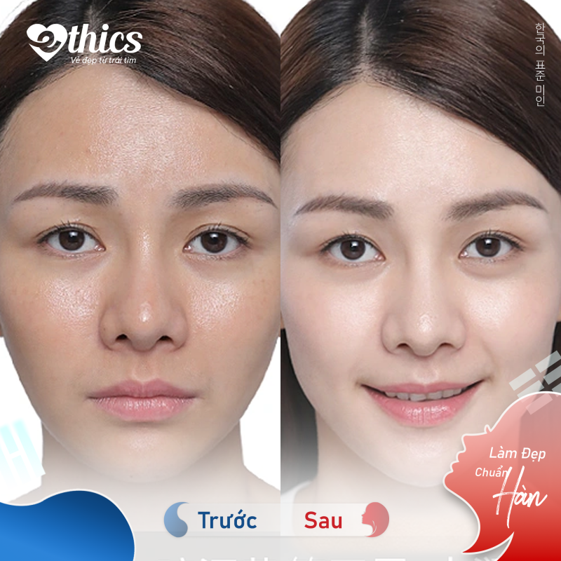 Hình ảnh trước - sau khi thực hiện liệu trình peel da 