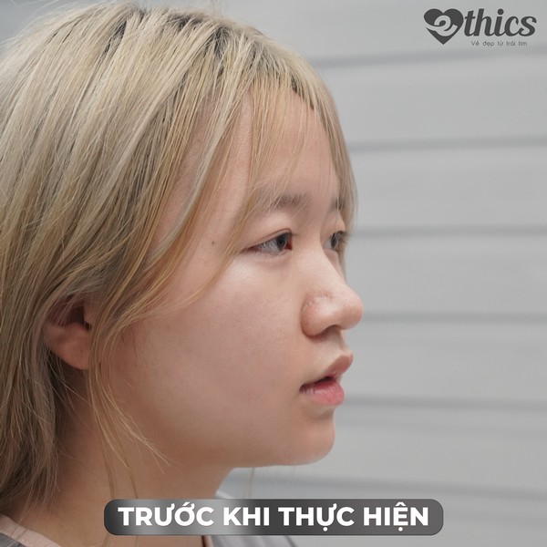 Hình ảnh Quỳnh Trang trước khi nâng mũi