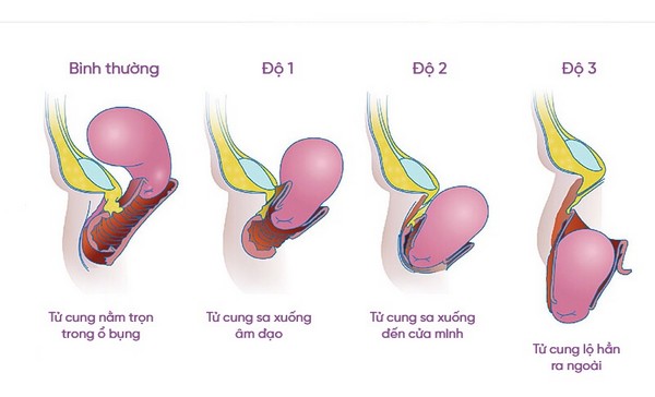 Các cấp độ sa trễ âm đạo