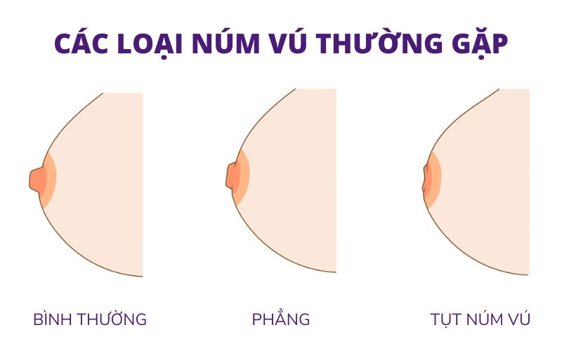 Các dạng núm vú thường gặp