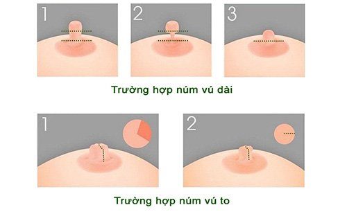 Kỹ thuật thu nhỏ đầu vú