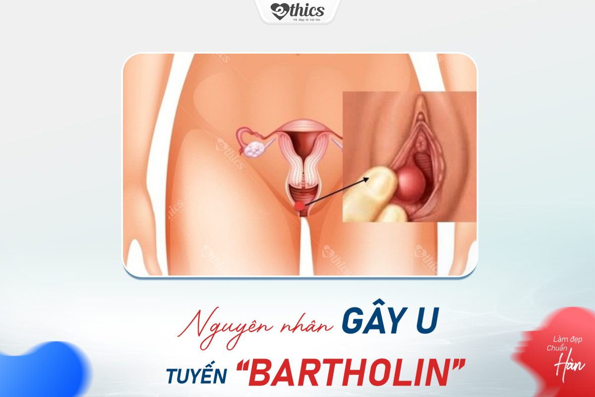 Nguyên nhân gây nên u tuyến Bartholin