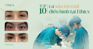 Top 10 ca sửa mí mắt điển hình tại Ethics