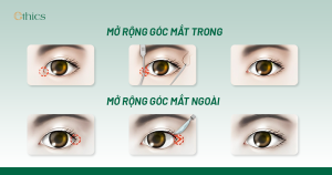 Mở góc mắt trong & Mở góc mắt ngoài – Phương pháp nào dành cho bạn?