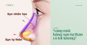 Nâng mũi cấu trúc bằng sụn tự thân có tốt hay không?