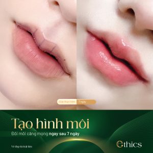 Tạo Hình Môi Trái Tim – Đẹp Tự Nhiên, Không Để Lại Sẹo