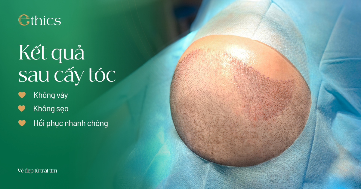 Cấy tóc tự thân tại Ethics 