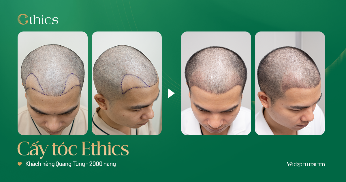 Kết quả khách hàng cấy tóc tự thân tại Ethics 